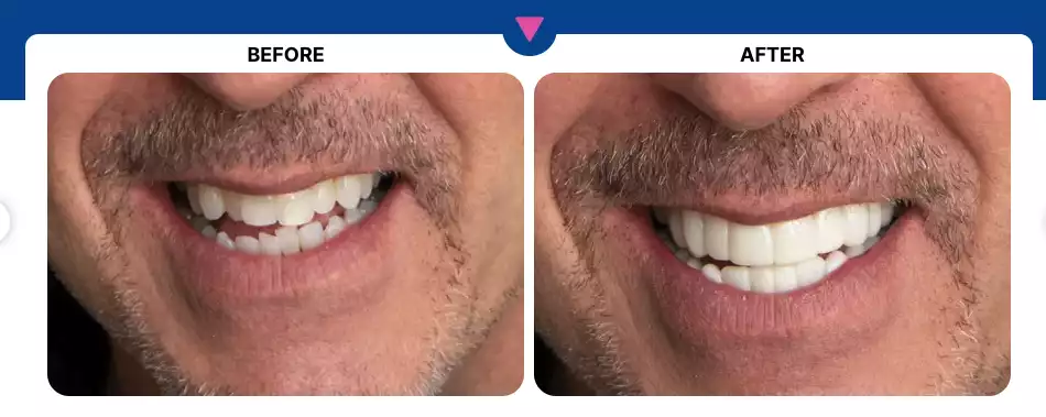 Product image of Shiny Smile Veneers